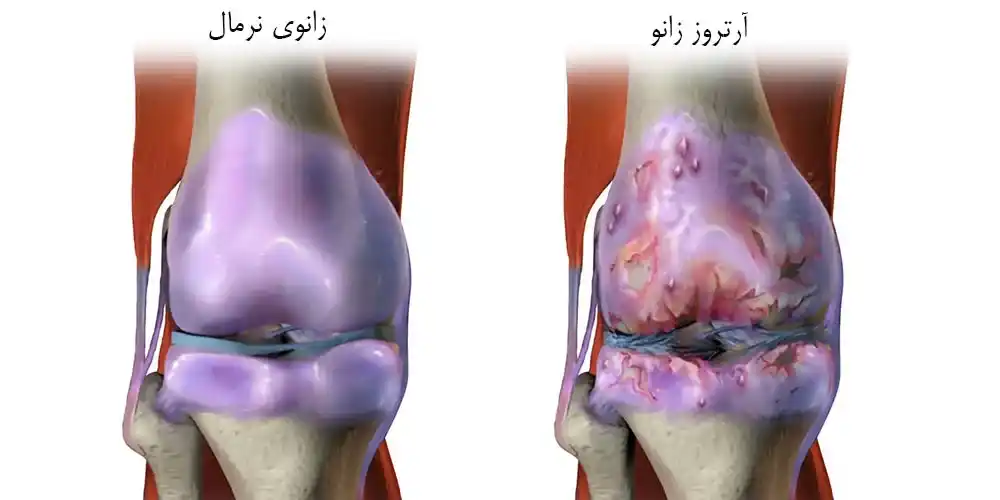 آرتروز 