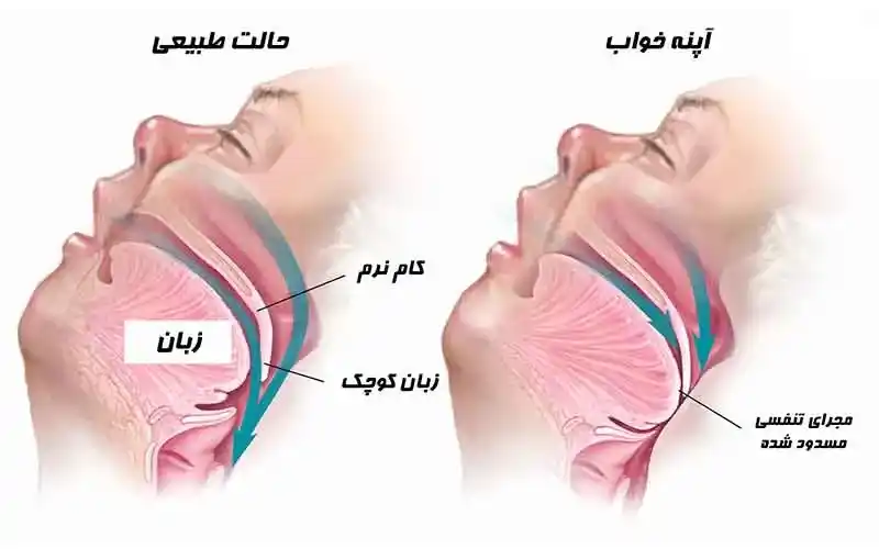 آپنه خواب