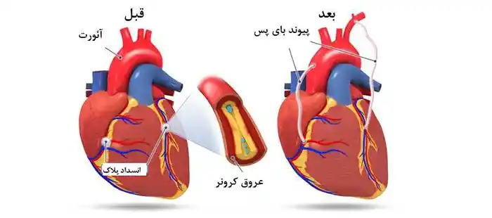 بای‌ پس قلب