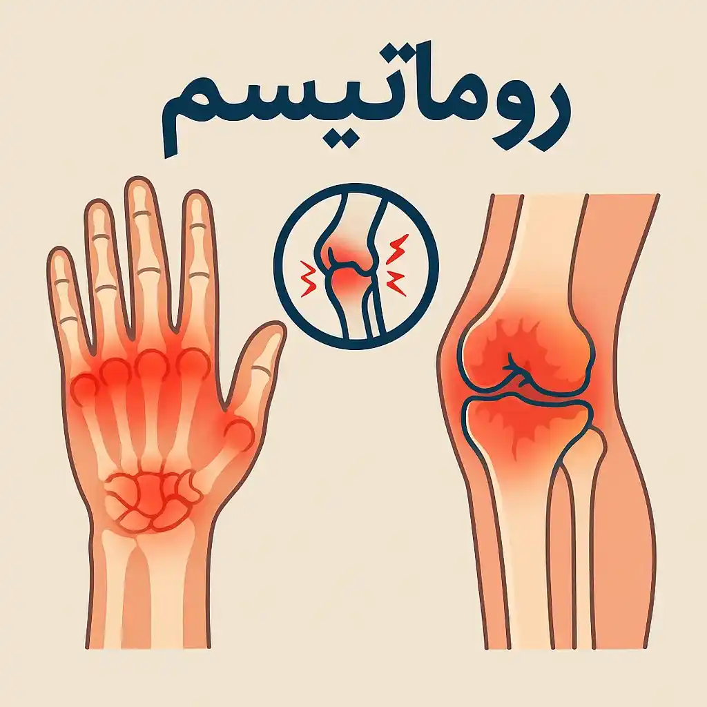 روماتیسم