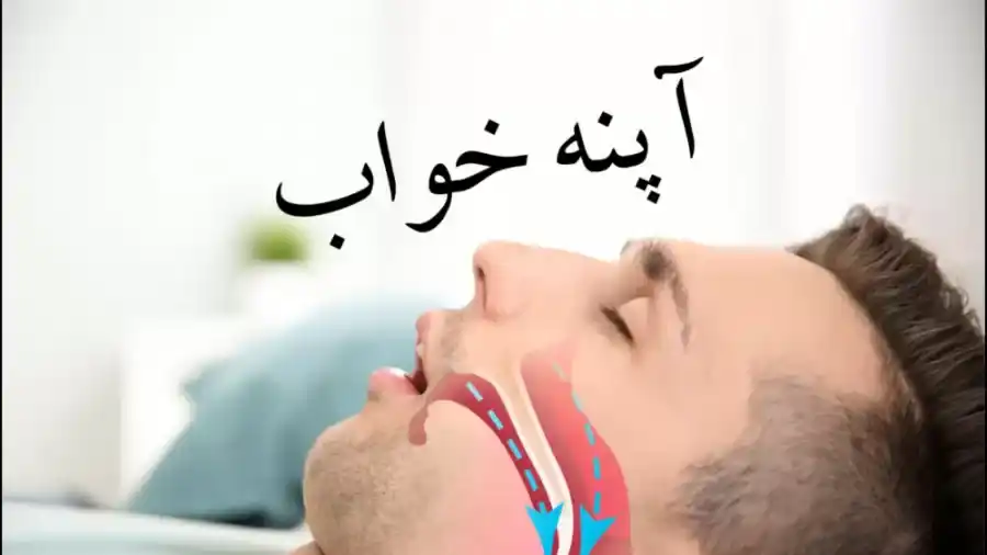 آپنه خواب